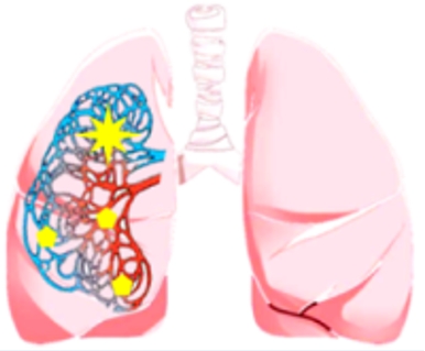 DNA de lesão pré-maligna de pulmão pode ser detectado no sangue